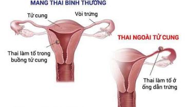 chửa ngoài dạ con