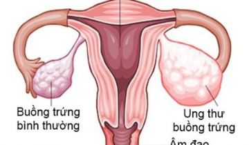ung thư buồng trứng