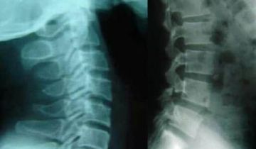 X-quang thoái hóa cột sống
