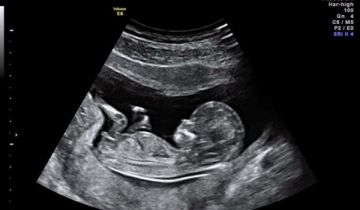 Nguyên nhân dẫn đến không có tim thai. 