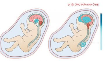 dị tật ống thần kinh. siêu âm. 