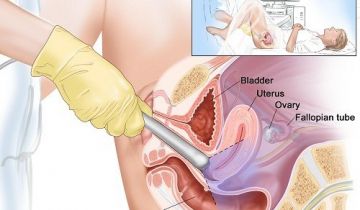 siêu âm, sieu am, buồng trứng 